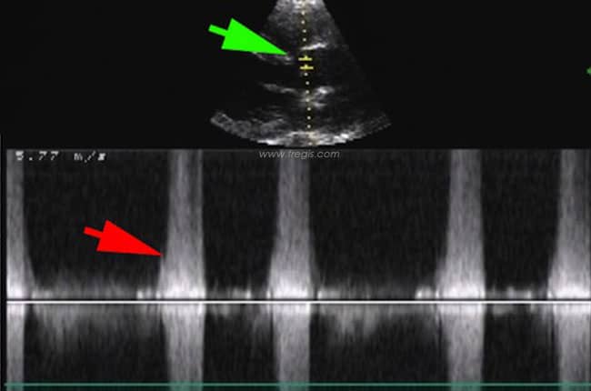 Echocardiographie d’une communication interventriculaire chez un chien