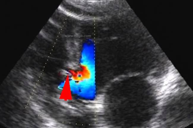 Echographie du cœur sur une très petite communication interventriculaire chez un chien