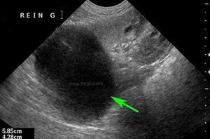 Echographie d’un volumineux kyste du rein sur un chien atteint de dermatofibrose nodulaire