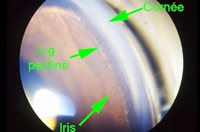 3. Sténose de la valve mitrale. Dans cette forme de dysplasie, l’ouverture de la valve est très anormalement diminuée (flèche verte)​