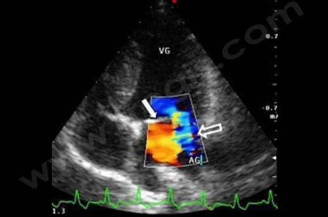 Echocardiographie d’un chien atteint d’endocardiose de la valve mitrale