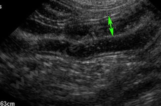 Echographie abdominale d’un chien atteint d’entérite lymphoplasmocytaire montrant un épaississement anormal de la paroi de l’intestin