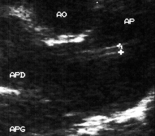 Echographie cardiaque d’un chien atteint de dirofilariose