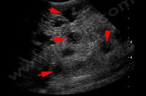 Echographie du foie montrant de multiples kystes de petite taille sur un chat atteint de maladie polykystique hépatique.