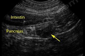 Echographie du pancréas d’un chien Labrador atteint d’un insulinome. On note un nodule anormal (flèche) dans le pancréas