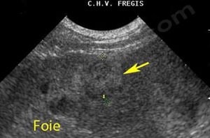 Echographie du foie d’un chien atteint d’un insulinome pancréatique. Le bilan d’extension a mise en évidence une métastase dans le foie (flèche). L’insulinome est un cancer souvent agressif