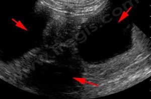 Echographie hépatique chez un chat souffrant de polykystose hépatique. Les kystes (flèches) sont ici très volumineux.