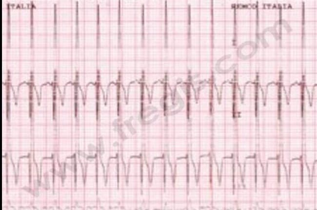 Electrocardiogramme d’un chien atteint d’une forme débutante d’endocardiose mitrale