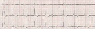 Electrocardiogramme réalisé chez un chat faisant des malaises et montrant une fréquence cardiaque trop basse, à cause d’une déficience dans le circuit électrique transmettant les impulsions. Cette fréquence s’élève ici à 70 battements par minute alors que la fréquence cardiaque d’un chat en consultation doit être normalement à environ plus de 160 battements par minute.