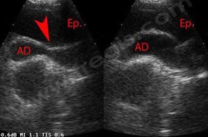 2. Echocardiographie d’un chien Berger allemand avec épanchement péricardique (Ep.). L’augmentation de pression provoque par moment « l’écrasement » (flèche) de l’oreillette droite (AD). On parle de tamponnade cardiaque