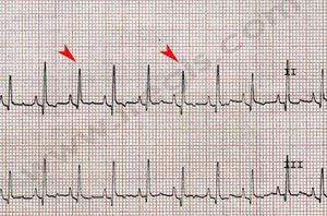 1. Electrocardiogramme (ECG) d’un chien Labrador retriever avec épanchement péricardique. Le tracé montre des anomalies (flèches) évocatrices