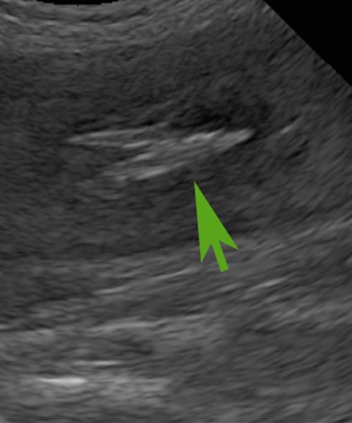 Échographie permettant de visualiser un épillet dans le muscle du bassin chez un chien