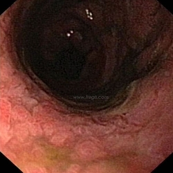 2. Examen endoscopique d’un chien boxer atteint de colite histiocytaire. Noter l’aspect prolifératif et ulcératif des lésions