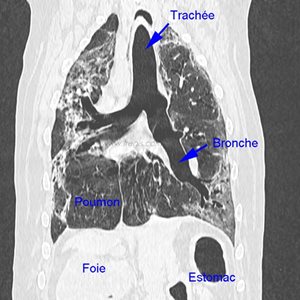 1. Scanner thoracique d’un West Highland White terrier de 13 ans présenté pour toux chronique réfractaire au traitement. Le parenchyme pulmonaire présente une densité anormalement augmentée et les bronches ont des parois dilatées et un épaississement modéré. Ces observations sont très évocatrices de fibrose pulmonaire