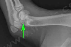 Vue latérale du même os que la photo 2. La fracture n’est que peu visible ce qui montre l’importance d’un bon diagnostic