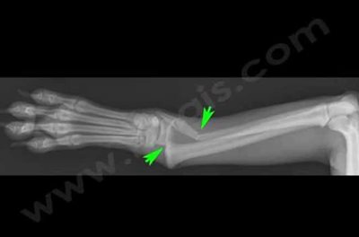 Fracture salter harris distale du radius d’un chiot de 5 mois