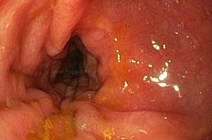 Endoscopie du colon (gros intestin) d’un chien atteint de colite éosinophilique