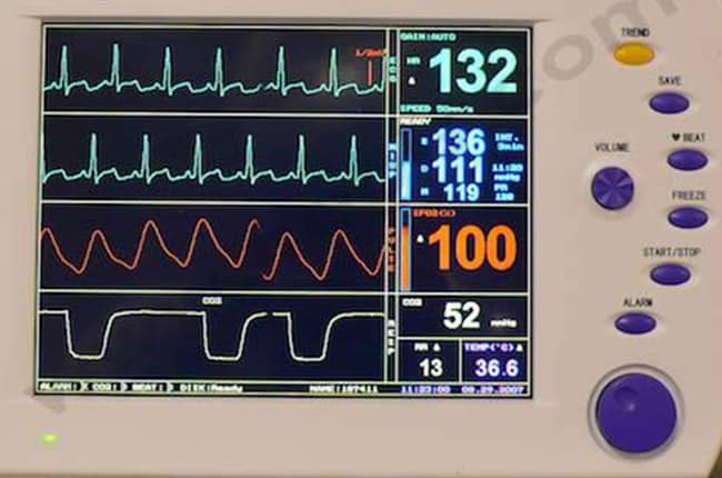 2. Un appareil de monitoring complet permet de surveiller les paramètres vitaux pendant l'anesthésie générale