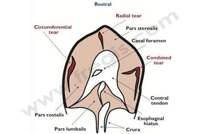 1. Schémas montrant les différents types de ruptures diaphragmatiques