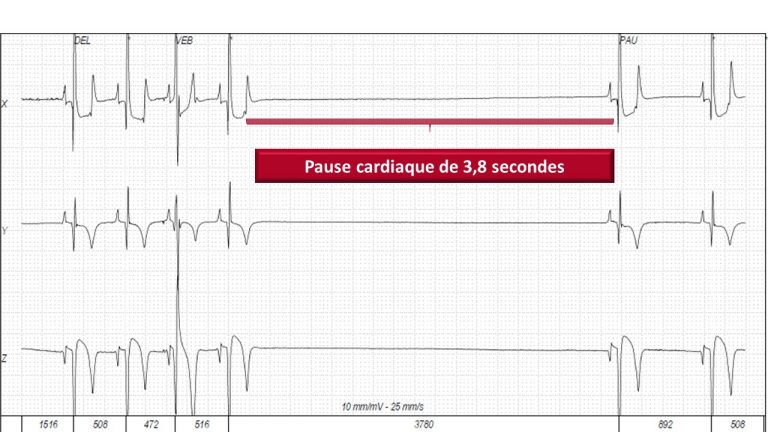 Résultat d’un Holter montrant que le cœur du chien s’arrête de battre pendant 3,8 secondes.