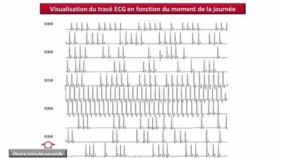 Résultat chez le chien d’un Holter