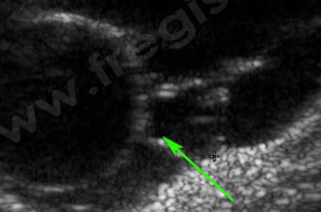 Echographie abdominale d’un kyste de l’ovaire chez une chienne, responsable d’un hyperoestrogénisme