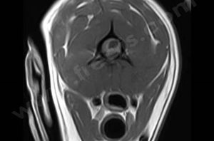 IRM montrant un trou dans la moelle épinière cervicale en coupe transversale