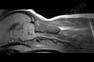 IRM montrant une accumulation de liquide dans la moelle épinière cervicale et engagement du cervelet au niveau de l'occiput