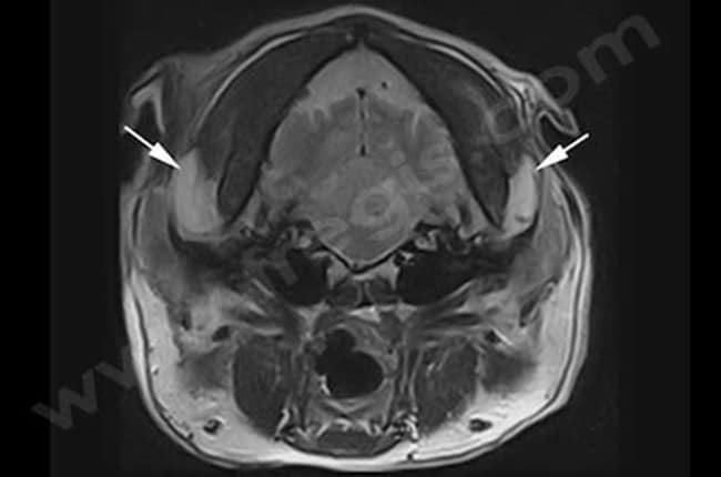 Myosite des muscles masticateurs chez le chien. L’IRM montre d’importantes lésions (flèches) des muscles masticateurs