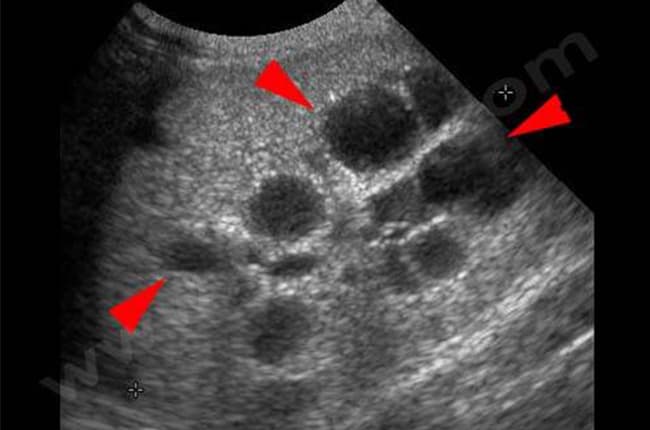 Echographie des reins d’un chat Persan atteint de polykystose rénale (PKD)