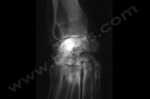 Radiographie du carpe d’un chien atteint de polyarthrite​