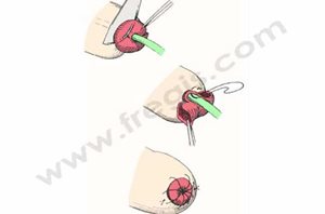 2. Traitement chirurgical du prolapsus urétral du chien (d’après Birchard)