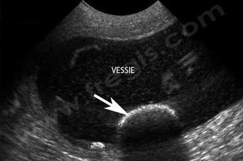 Echographie de l’abdomen d’un chien souffrant de lithiase urinaire vésicale (calcul dans la vessie). La surface d’un gros calcul (flèche) est ici bien visible