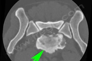 2. Scanner de la région lombo-sacrée du même chien en reconstruction sagittale et transverse. L’espace intervertébral entre L7 et S1 est collabé, une prolifération osseuse ventrale est présente. La coupe transverse met en évidence des zones lytiques au niveau des plateaux vertébraux.