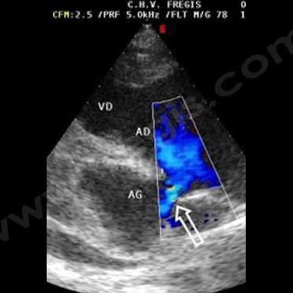 2. Echocardiographie avec Doppler codé couleur. La cloison entre l'oreillette droite (AD) et l'oreillette gauche (AG) n'est pas complète. Un jet de sang (flèche) passe de l'une à l'autre. On parle de communication inter-atriale (ou inter-auriculaire) (VD : ventricule droit)