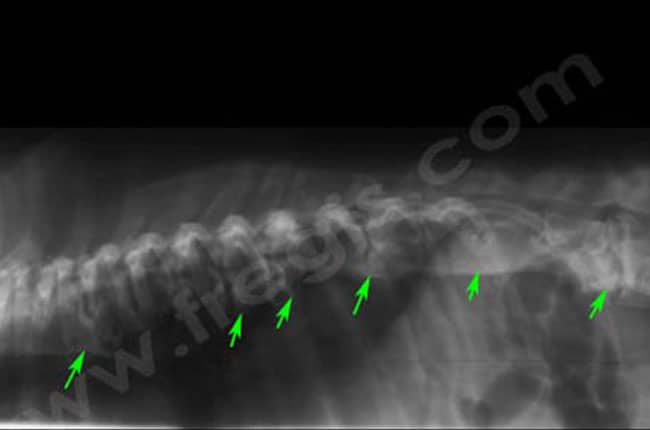 spondylarthrose