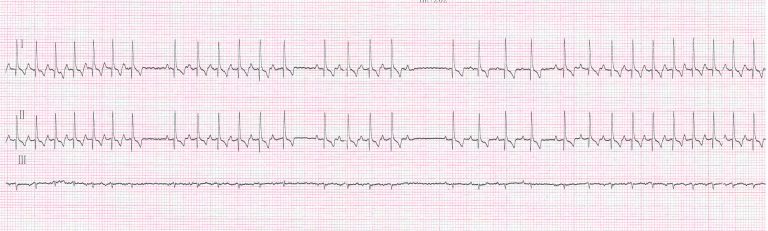 Électrocardiogramme d’un chien atteint d’un syndrome de déficience du tissu nodal (ou Sick Sinus Syndrome).