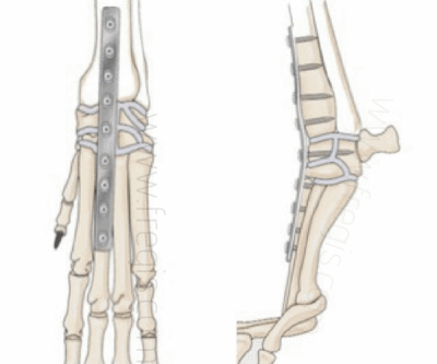 Schémas de mise en place de la plaque d’ostéosynthèse lors d’arthrodèse totale du carpe chez le chien