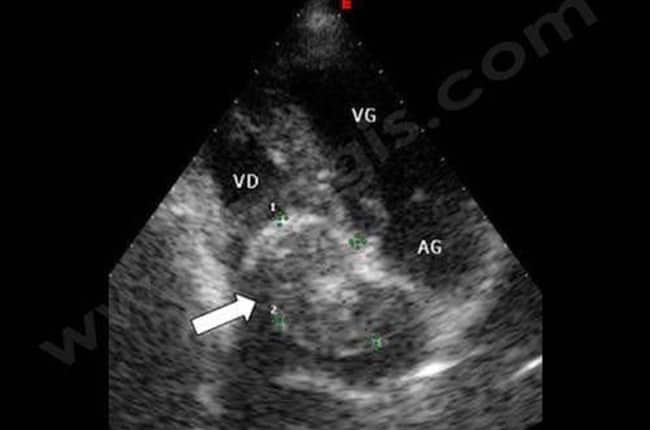 Examen échocardiographique montrant une trés volumineuse tumeur à l'intérieur du coeur (flèche)