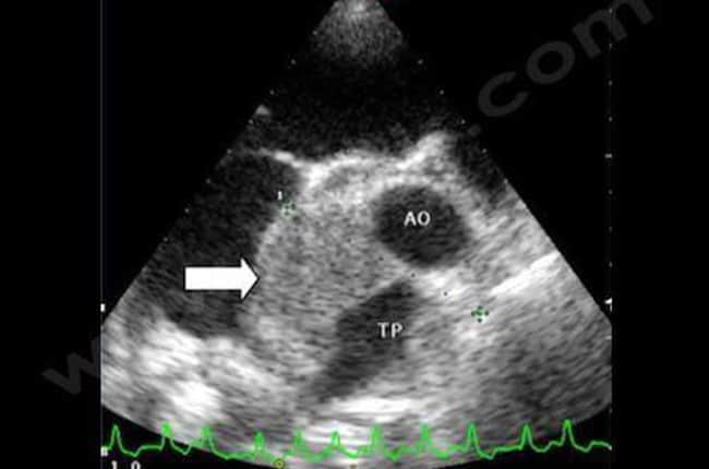 Examen échocardiographique. On note la présence d'une tumeur (flèche)