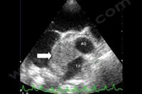 3. Examen échocardiographique. On note la présence d'une tumeur