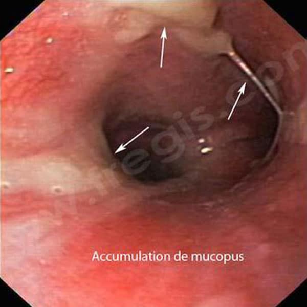 Une fibroscopie respiratoire