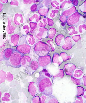 Myélogramme qui permet l’étude des nombreuses cellules de la moelle osseuse