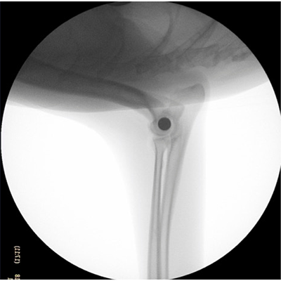 Figure 4 : Le bon placement final de la vis est confirmé sous fluoroscopie