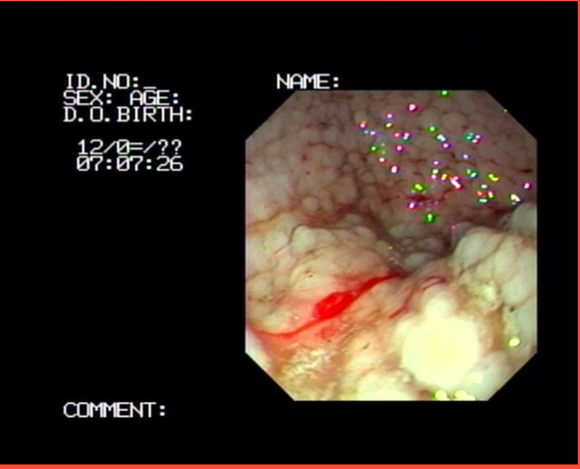 Examen histologique des biopsies réalisées sous endoscopie