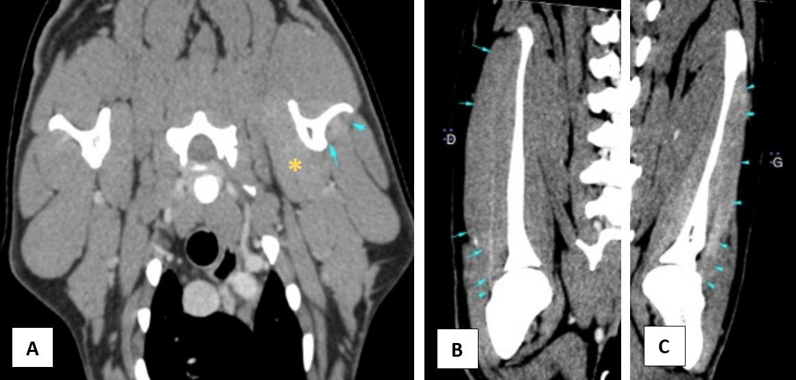 Images scanner des épaules en coupe transverse (A) et en coupe longitudinale (B à droite et C à gauche). Sur le cliché A, les flèches bleues indiquent le tendon du muscle infra-épineux gauche fibrosé et l’étoile orange indique le muscle sous-scapulaire gauche hypertrophié. Sur les clichés B et C, les flèches bleues délimitent le muscle infra-épineux, nettement atrophié à gauche.