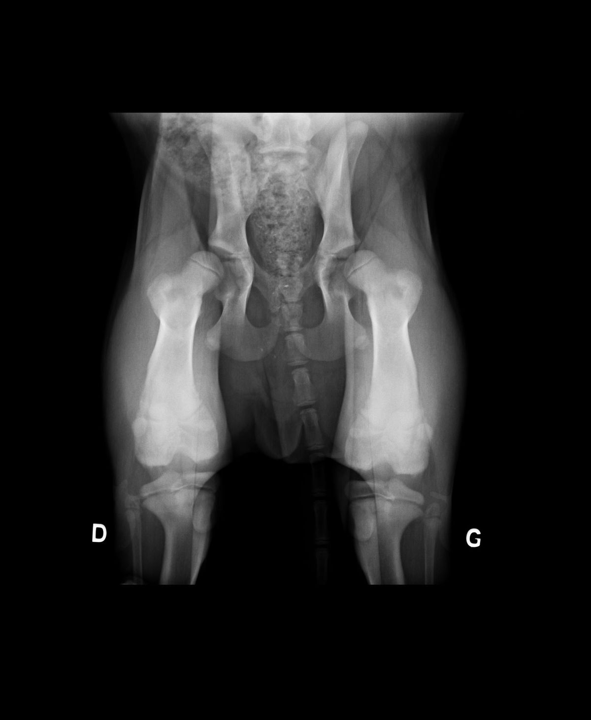 Radiograpie de dépistage précoce de dysplasie en distraction avec le distracteur de Vezzoni (décubitus dorsal, hanches à environ 110° et grassets à 90°, distracteur positionné entre les têtes fémorale jouant le rôle de levier, permettant un déplacement latéral des têtes fémorales lorsqu’une adduction modérée est réalisée).