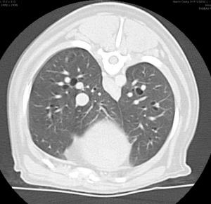 scanner après injection de produit de contraste d’un thorax.