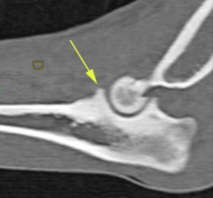 scanner d’un coude de chien avec mise en évidence d’une atteinte du processus coronoïde médial