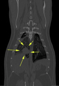 scanner thoracique avec mise en évidence d’une tumeur pulmonaire